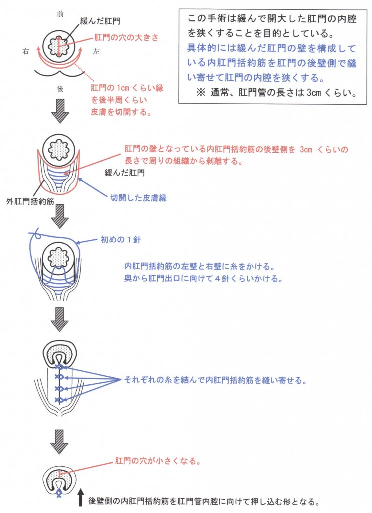 直腸脱の手術方法