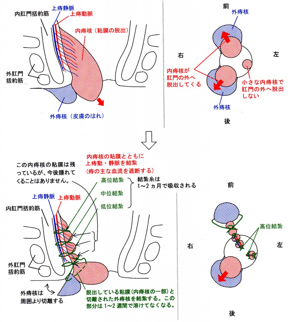 内外痔核、脱肛の手術法